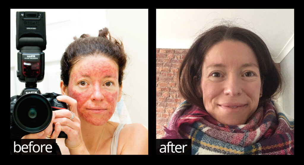 Before and after image of woman who improved skin on face using Chuckling Goat probiotic lotions.