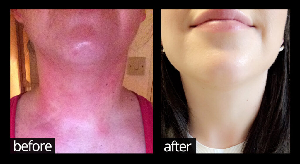Before and after images of skin on face showing improvements