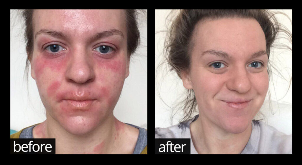 Before and after images of skin on face showing improvements