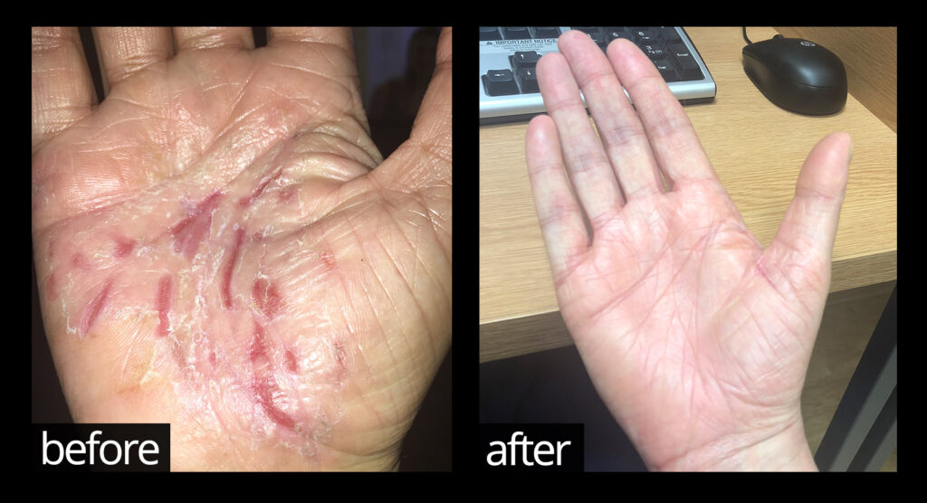 Before and after images of skin on hands showing improvements