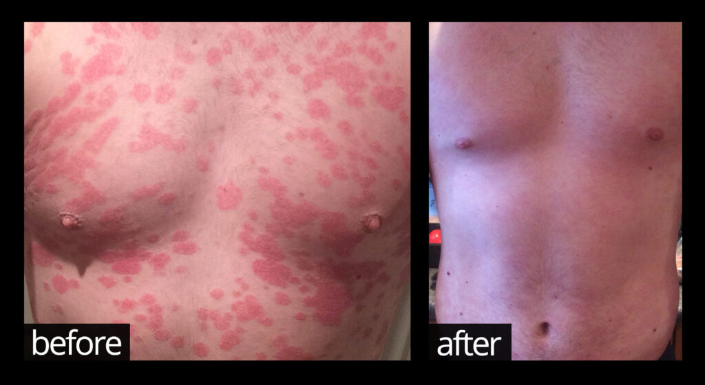 Before and after images of skin on chest and stomach showing improvements